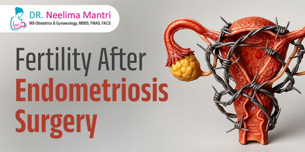 Fertility After Endometriosis Surgery