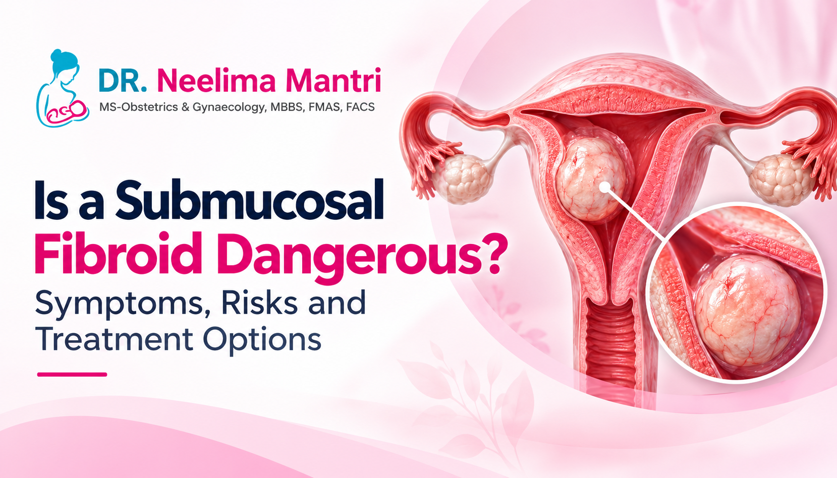 Is a Submucosal Fibroid Dangerous? Symptoms, Risks and Treatment Options
